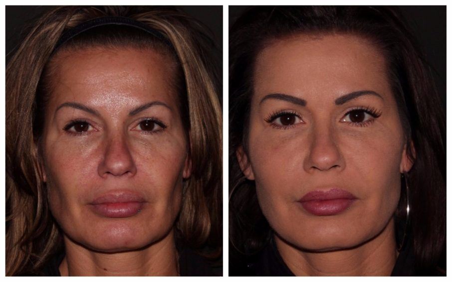 Fat Transfer Grafting Dermal Filler Broomfield Denver