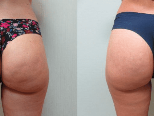 Introducing Avelli for Cellulite