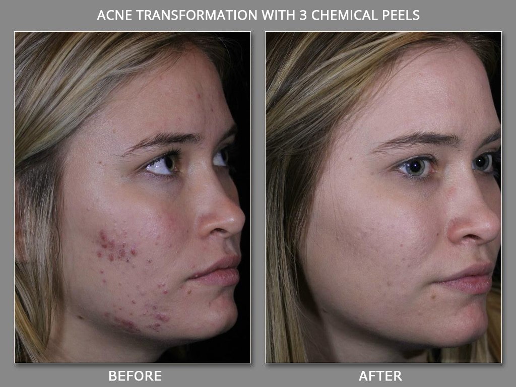 Safe & Natural Acne Treatments | Med Spa | Denver | Colorado