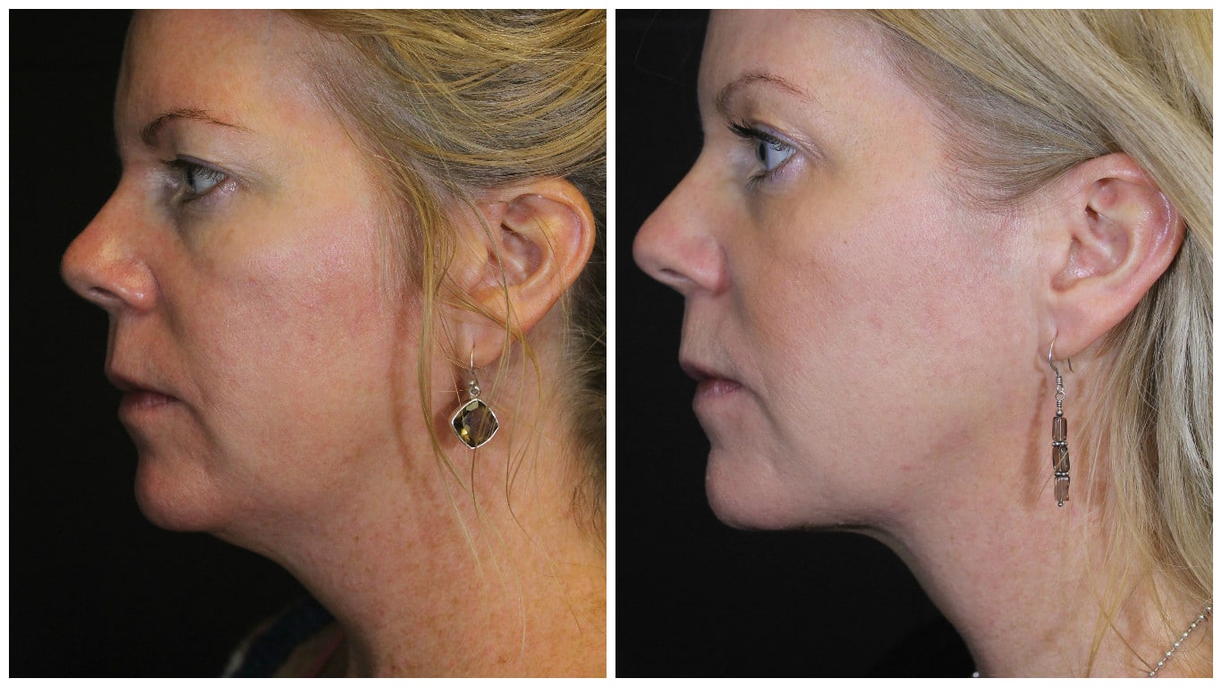 Ever/Body - Defining the jawline with Kybella! This “after” photo