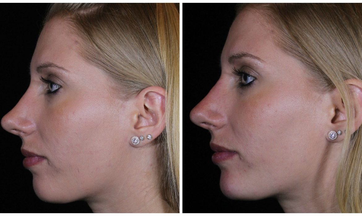 Botox Nose Slimming