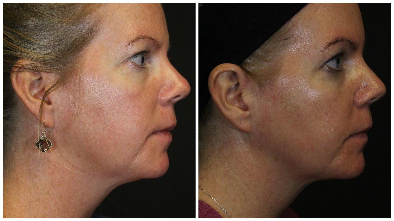 Kybella Success Story | Denver & Broomfield Med Spa